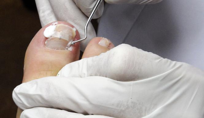 Nagelreparatie